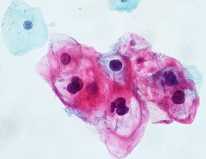 HPV-Neoplasien: Nachweis auch zu Hause möglich (Foto: Flickr/Uthmann)