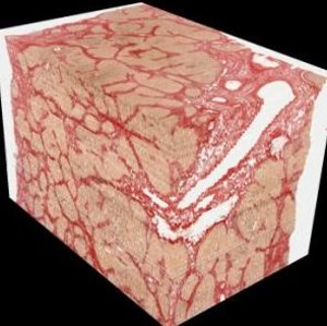 Gewebe in 3D: bessere Diagnose möglich (Foto: American Journal of Pathology)