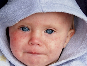 Masern: Impfung in Zukunft vielleicht nicht mehr nötig (Foto: Flickr/Haygarth)