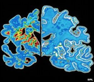 Alzheimer als Gehirnerkrankung: Plaques lagern sich ab (Foto: SPL)