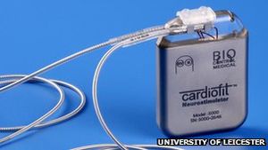 Implantat: Cardiofit soll Herz auf die Sprünge helfen (Foto: le.ac.uk)