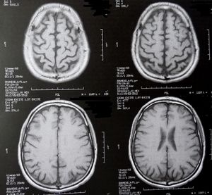 Gehirnscans: machen Verhaltensstörungen sichtbar (Foto: pixelio.de, D. Schütz)