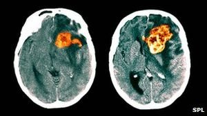 Bluttest erkennt Gehirntumore – Magnetische Nanopartikel liefern Hinweise auf Krebserkrankung