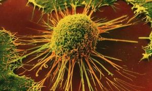 Leberkrebs: Virus verdreifacht Überlebenszeit – 200 Patienten getestet – „Pexa-Vec“ zerstört Primär- und Sekundärtumore