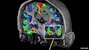 Gehirnscan: frühere Diagnose von Alzheimer denkbar (Foto: cell.com/neuron)