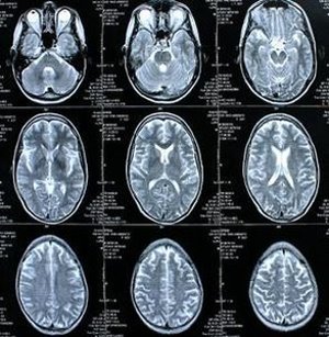 Forscher wollen Gehirn im Labor nachzüchten – Implantate sollen eines Tages im klinischen Betrieb eingesetzt werden