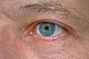 Blindheit: Gentherapie verbessert Sehkraft immens – Mediziner verzeichnen erste Erfolge bei Chorioideremie-Behandlung