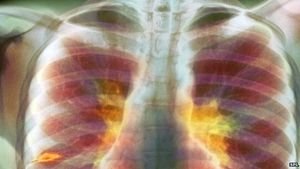 Tuberkulose: Erkrankungen gehen in China deutlich zurück (Foto: SPL)