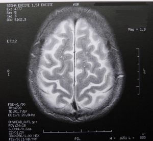 Milliarden sollen Gehirnforschung voranbringen – Hoffnung auf neue Therapien bei neurologischen Erkrankungen